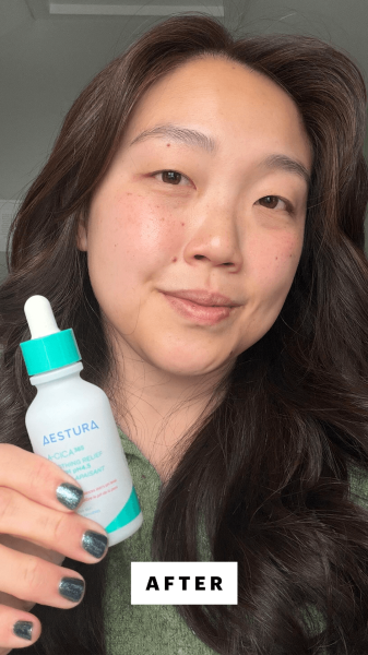 Lee after applying the Aestura ACica365 Soothing Relief Serum pH4.5
